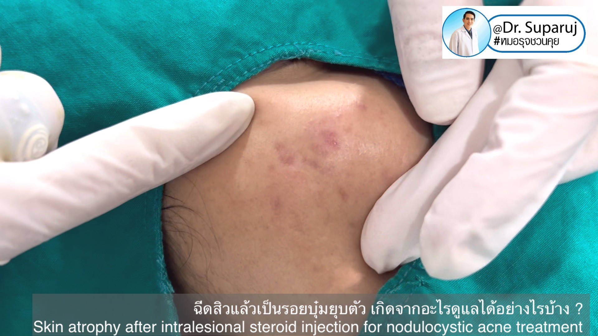 ฉีดสิวแล้วเป็นรอยบุ๋มยุบตัว เกิดจากอะไรดูแลได้อย่างไรบ้าง ?  (Skin atrophy after intralesional steroid injection for nodulocystic acne treatment )