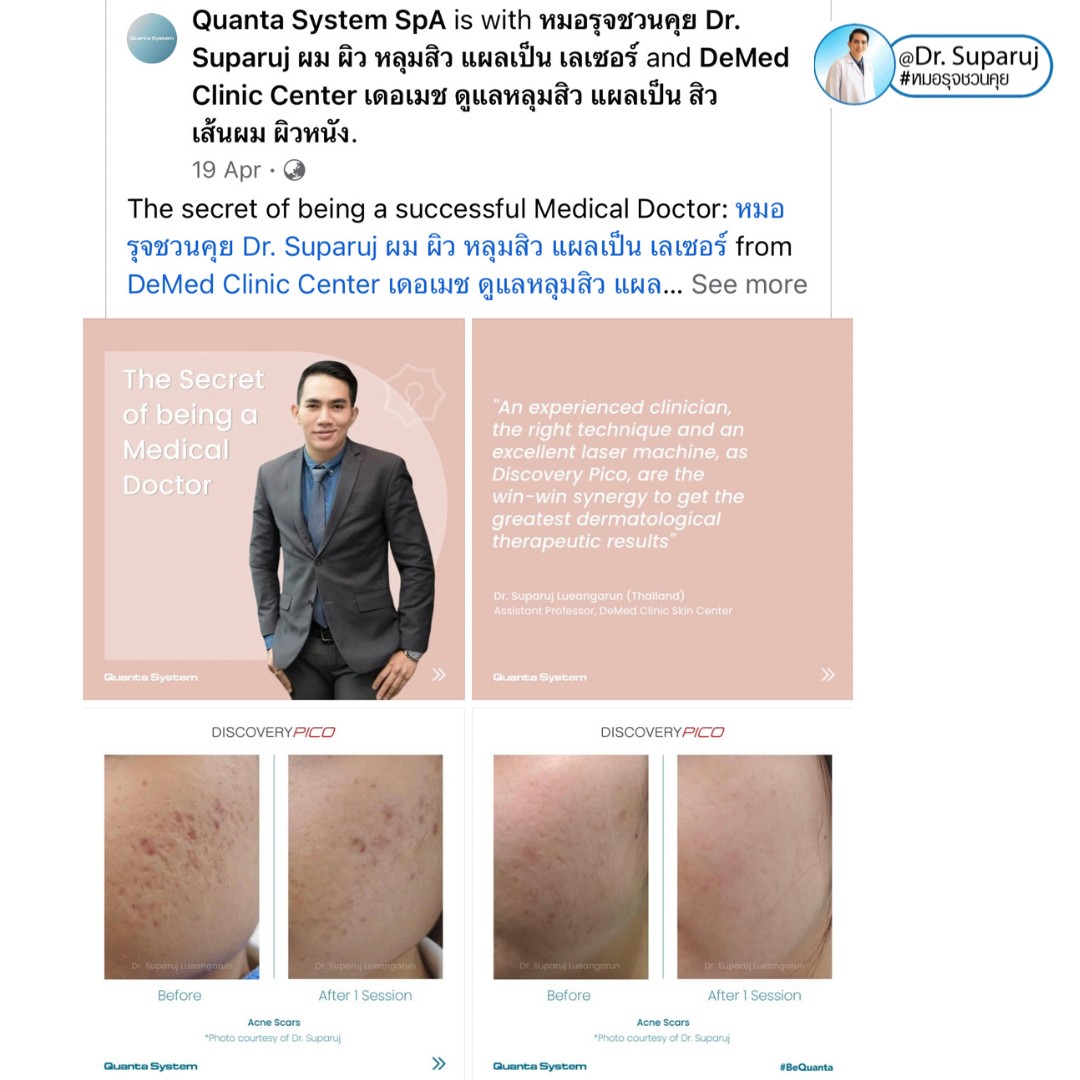 เทคนิคหลักการรักษาหลุมสิวด้วยเลเซอร์ Diacovery Pico Laser ของหมอรุจได้รับการเผยแพร่ในระดับนานาชาติของทางบริษัทระดับโลก Quanta System จากประเทศอิตาลีครับ เทคนิคหลักการรักษาหลุมสิวด้วยเลเซอร์ Diacovery Pico Laser ของหมอรุจได้รับการเผยแพร่ในระดับนานาชาติของทางบริษัทระดับโลก Quanta System จากประเทศอิตาลีครับ