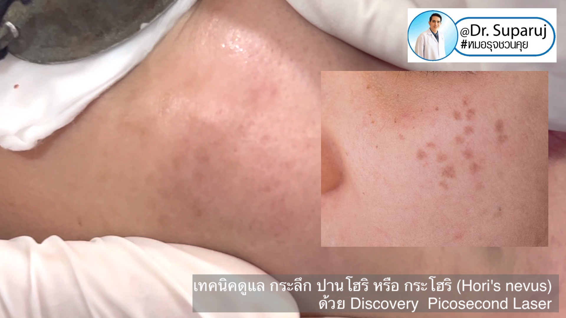 เทคนิครักษากระโฮริ กระลึก ปานโฮริ (Hori's nevus) ด้วยเลเซอร์ Discovery Picosecond Laser เทคนิครักษากระโฮริ กระลึก ปานโฮริ (Hori's nevus) ด้วยเลเซอร์ Discovery Picosecond Laser
