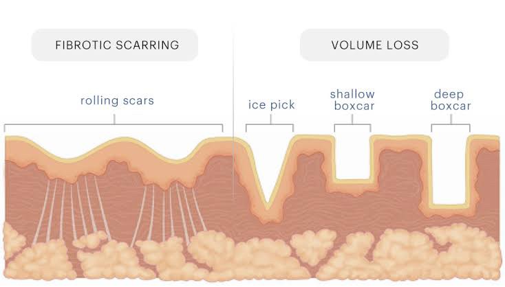 เทคนิคการประเมินพังผืด และการตัดพังผืดหลุมสิว Cannula Subcision ทำไมต้องตัดพังผืดรักษาหลุมสิว ?(Acne Scar Fibrosis Evaluation & Cannula Subcision Treatment) 