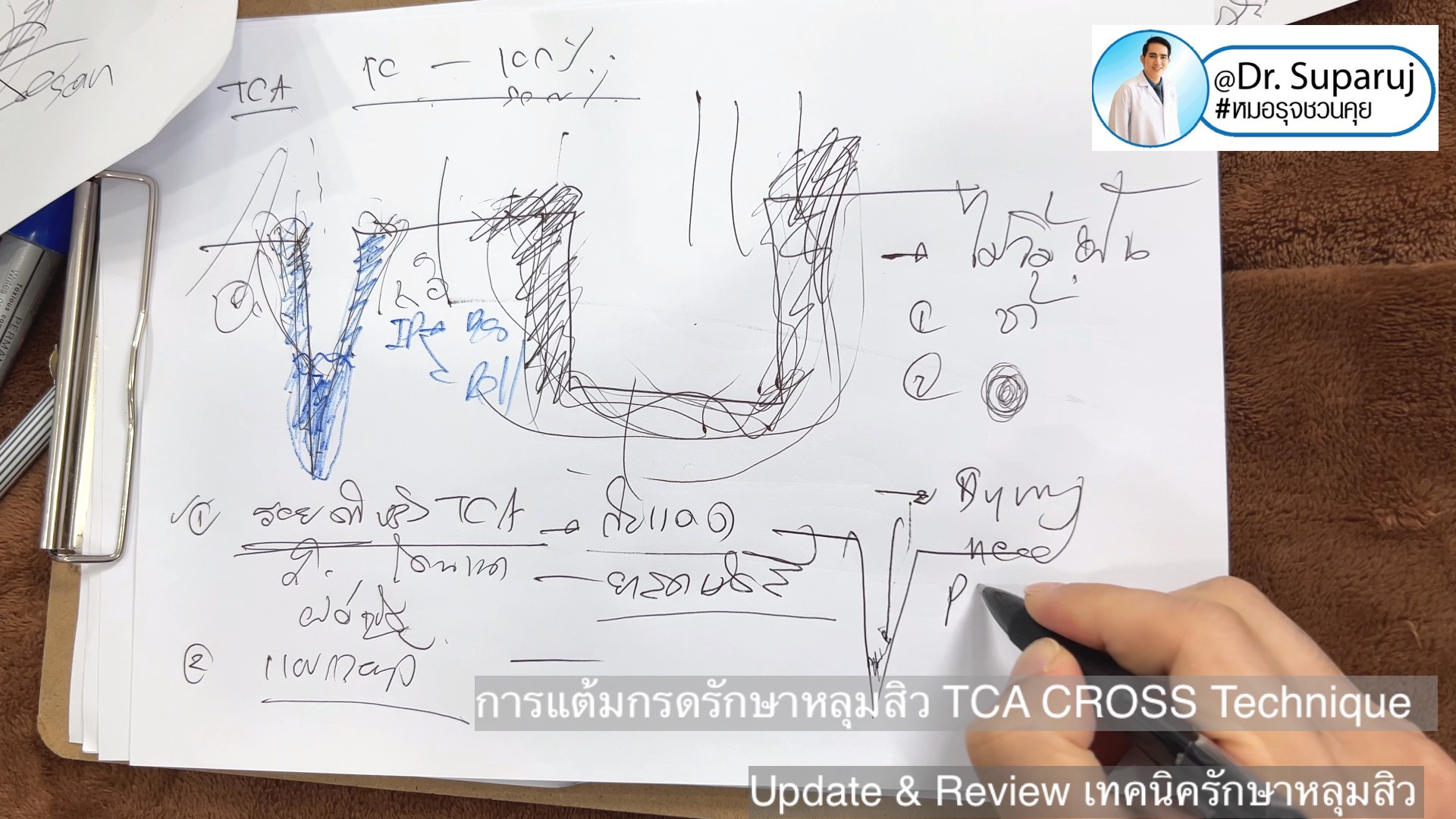 Update & Review เทคนิครักษาหลุมสิว (Acne Scar Treatment: Update & Review) Update & Review เทคนิครักษาหลุมสิว (Acne Scar Treatment: Update & Review)