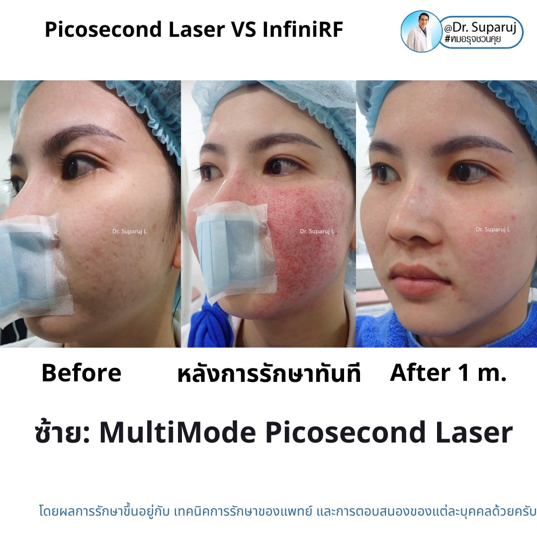 แนะนำเทคนิครักษาหลุมสิว: ดูแลหลุมสิวด้วยเข็มพลังงานคลื่นวิทยุ Infini RF Microneedle แนะนำเทคนิครักษาหลุมสิว: ดูแลหลุมสิวด้วยเข็มพลังงานคลื่นวิทยุ Infini RF Microneedle