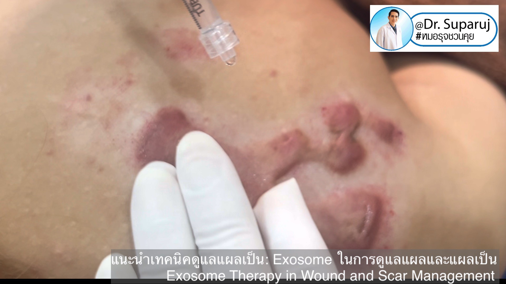 แนะนำเทคนิคดูแลแผลเป็น: Exosome ในการดูแลแผลและแผลเป็น Exosome Therapy in Wound and Scar Management แนะนำเทคนิคดูแลแผลเป็น: Exosome ในการดูแลแผลและแผลเป็น Exosome Therapy in Wound and Scar Management