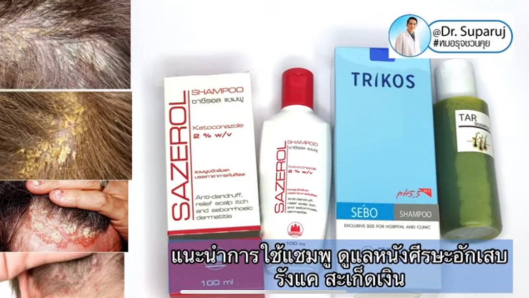 แนะนำเทคนิคการใช้แชมพู ดูแลหนังศีรษะอักเสบ รังแค เซ็บเดิร์ม สะเก็ดเงิน แนะนำเทคนิคการใช้แชมพู ดูแลหนังศีรษะอักเสบ รังแค เซ็บเดิร์ม สะเก็ดเงิน