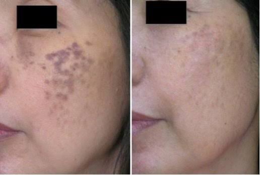 เทคนิครักษากระโฮริ กระลึก ปานโฮริ (Hori's nevus) ด้วยเลเซอร์ Discovery Picosecond Laser เทคนิครักษากระโฮริ กระลึก ปานโฮริ (Hori's nevus) ด้วยเลเซอร์ Discovery Picosecond Laser