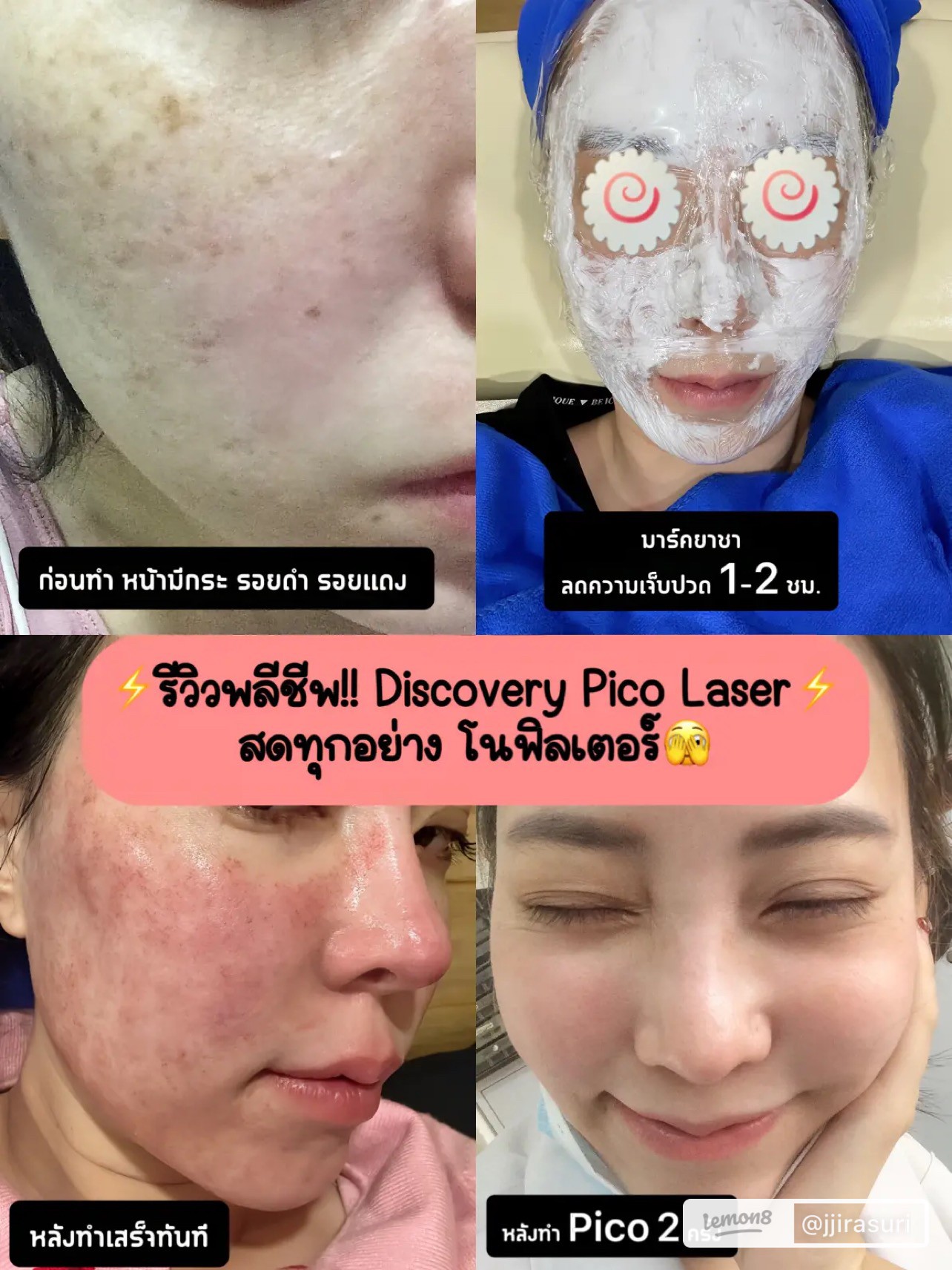 แนะนำเทคนิคดูแลรูขุมขนกว้าง: เทคนิคดูแลรูขุมขนกว้างด้วย Deep Carbon Peel Picosecond Laser (เทคนิคการใช้ Picosecond Laser พิโค่เลเซอร์ ร่วมกับผง carbon กระตุ้นการสร้างคอลลาเจนดูแลรูขุมขนกว้าง )