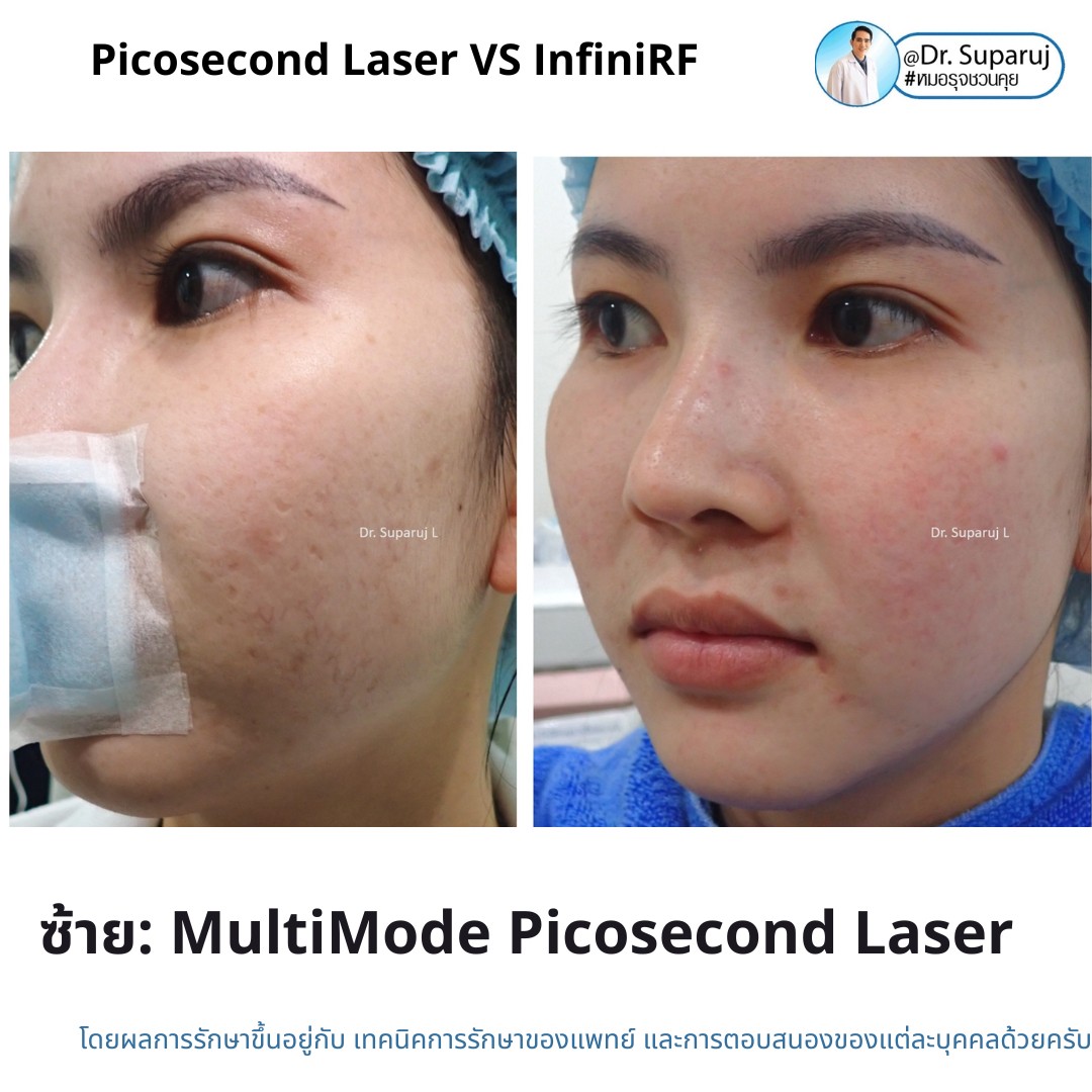 แนะนำเทคนิครักษาหลุมสิว: ดูแลหลุมสิวด้วยเข็มพลังงานคลื่นวิทยุ Infini RF Microneedle แนะนำเทคนิครักษาหลุมสิว: ดูแลหลุมสิวด้วยเข็มพลังงานคลื่นวิทยุ Infini RF Microneedle