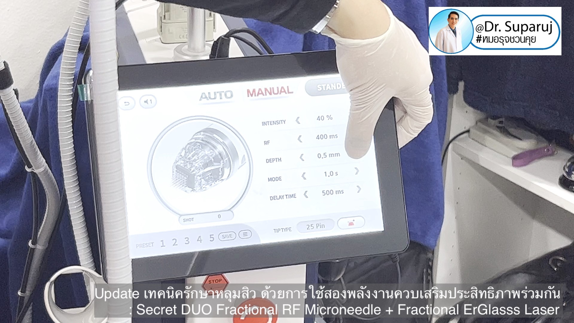 Update เทคนิครักษาหลุมสิว ด้วยการใช้สองพลังงานเสริมประสิทธิภาพร่วมกัน: Secret DUO Fractional RF Microneedle + Fractional ErGlasss Laser