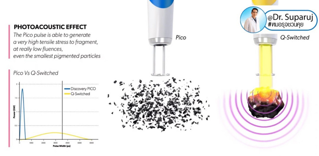 Update Discovery Picosecond Laser จุดเด่น & หลักการทำงาน ใช้ดูแลหลุมสิว แผลเป็น รอยแตกลาย ฝ้า กระจุดด่างดำ ได้อย่างไร ? 