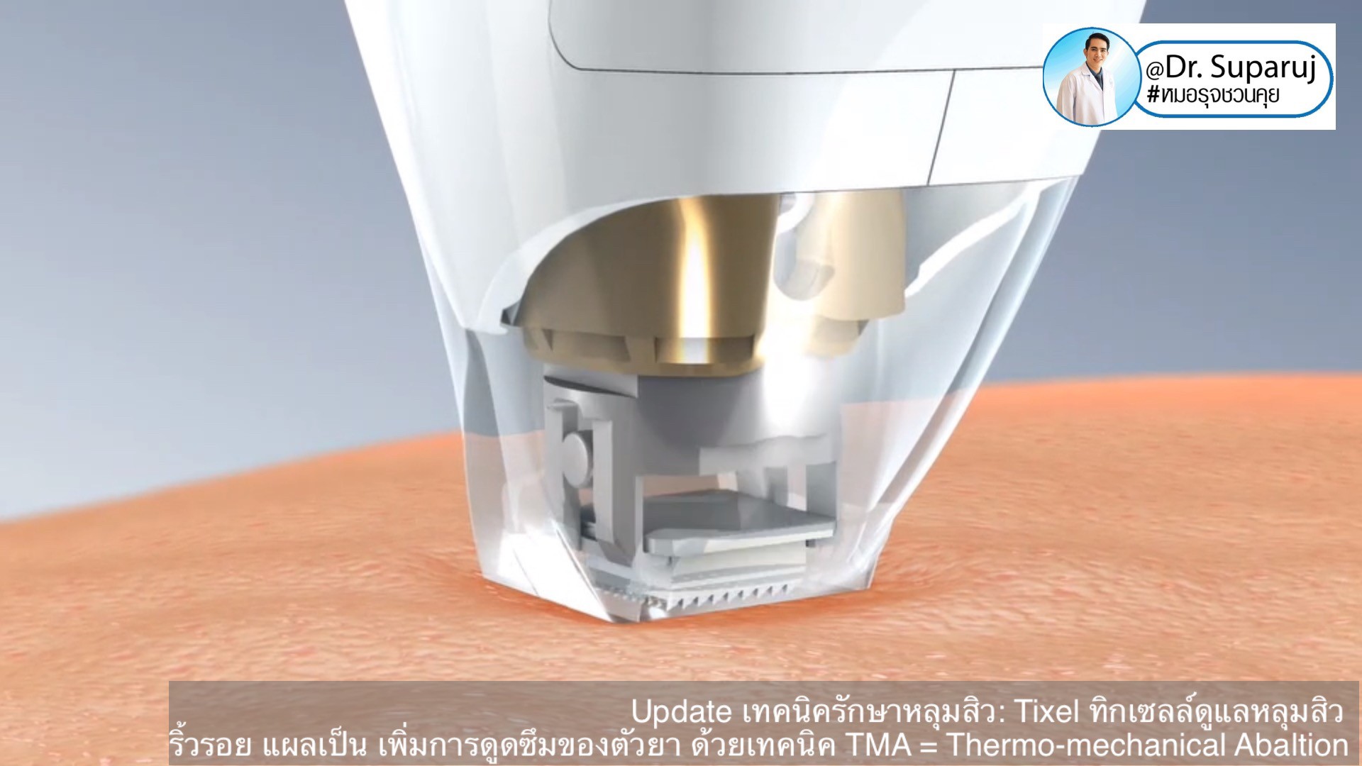 Update เทคนิครักษาหลุมสิว: Tixel ทิ๊กเซลล์ รักษาหลุมสิว ริ้วรอย แผลเป็น เพิ่มการดูดซึมยาด้วยเทคนิค TMA = Thermo-mechanical Abaltion Update เทคนิครักษาหลุมสิว: Tixel ทิ๊กเซลล์ รักษาหลุมสิว ริ้วรอย แผลเป็น เพิ่มการดูดซึมยาด้วยเทคนิค TMA = Thermo-mechanical Abaltion