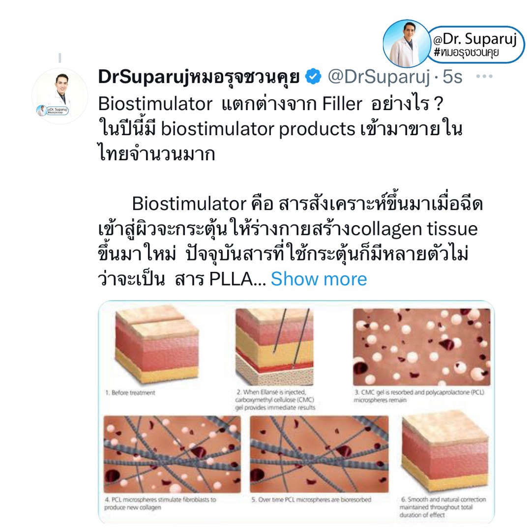 Update เทคนิคกระตุ้นการสร้างคอลลาเจนในผิวหนังลดเลือนริ้วรอย: Collagen Biostimulator