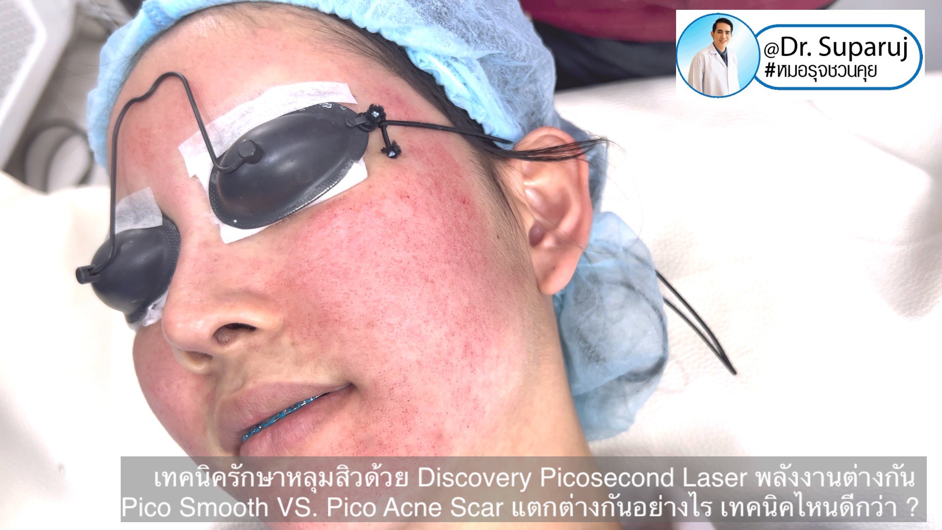 Q:Picosecond Laser หลุมสิวต้องยิงให้เลือดสาดไหม? Q:Picosecond Laser หลุมสิวต้องยิงให้เลือดสาดไหม?