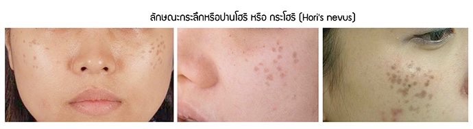 เทคนิครักษากระโฮริ กระลึก ปานโฮริ (Hori's nevus) ด้วยเลเซอร์ Discovery Picosecond Laser เทคนิครักษากระโฮริ กระลึก ปานโฮริ (Hori's nevus) ด้วยเลเซอร์ Discovery Picosecond Laser