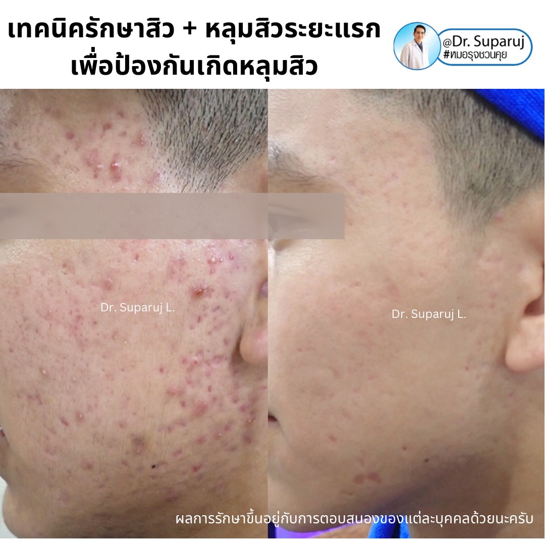 แนะนำเทคนิคดูแลรักษาสิวและหลุมสิว: ดูแลรอยแดงจากสิวและแผลเป็นยุบตัวจากสิว Acne + Macular acne erythema + Atrophic acne scar ดูแลด้วย Picosecond Laser + Healite + Medication