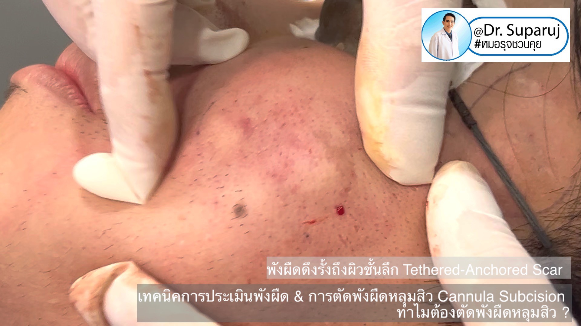 เทคนิคการประเมินพังผืด และการตัดพังผืดหลุมสิว Cannula Subcision ทำไมต้องตัดพังผืดรักษาหลุมสิว ?(Acne Scar Fibrosis Evaluation & Cannula Subcision Treatment) เทคนิคการประเมินพังผืด และการตัดพังผืดหลุมสิว Cannula Subcision ทำไมต้องตัดพังผืดรักษาหลุมสิว ?(Acne Scar Fibrosis Evaluation & Cannula Subcision Treatment)