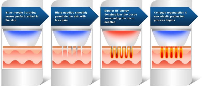 แนะนำเทคนิครักษาผมร่วงผมบาง: เทคนิครักษาผมร่วงผมบางด้วยการใช้เข็มพลังงานคลื่นวิทยุ Fractional Radiofrequency Microneedle FRM Anti-Hair Loss Technique แนะนำเทคนิครักษาผมร่วงผมบาง: เทคนิครักษาผมร่วงผมบางด้วยการใช้เข็มพลังงานคลื่นวิทยุ Fractional Radiofrequency Microneedle FRM Anti-Hair Loss Technique