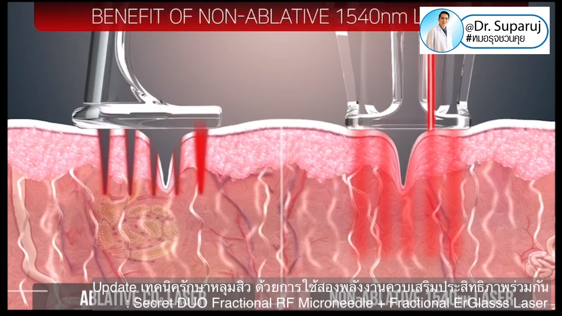 Update เทคนิครักษาหลุมสิว ด้วยการใช้สองพลังงานเสริมประสิทธิภาพร่วมกัน: Secret DUO Fractional RF Microneedle + Fractional ErGlasss Laser