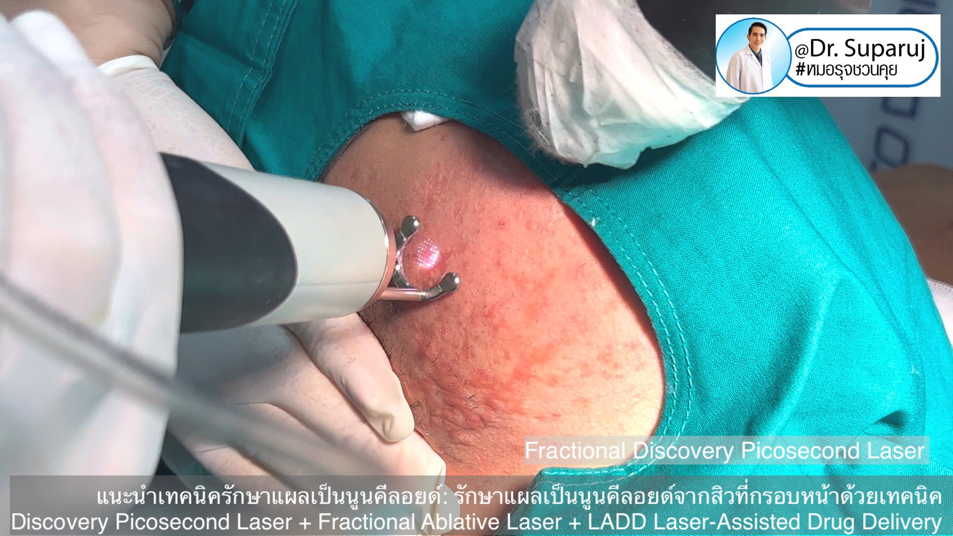 แนะนำเทคนิคดูแลแผลเป็นนูนคีลอยด์: รักษาแผลเป็นนูนคีลอยด์จากสิวที่กรอบหน้าด้วยเทคนิค Discovery Picosecond Laser + Fractional Ablative Laser + LADD Laser-Assisted Drug Delivery แนะนำเทคนิคดูแลแผลเป็นนูนคีลอยด์: รักษาแผลเป็นนูนคีลอยด์จากสิวที่กรอบหน้าด้วยเทคนิค Discovery Picosecond Laser + Fractional Ablative Laser + LADD Laser-Assisted Drug Delivery