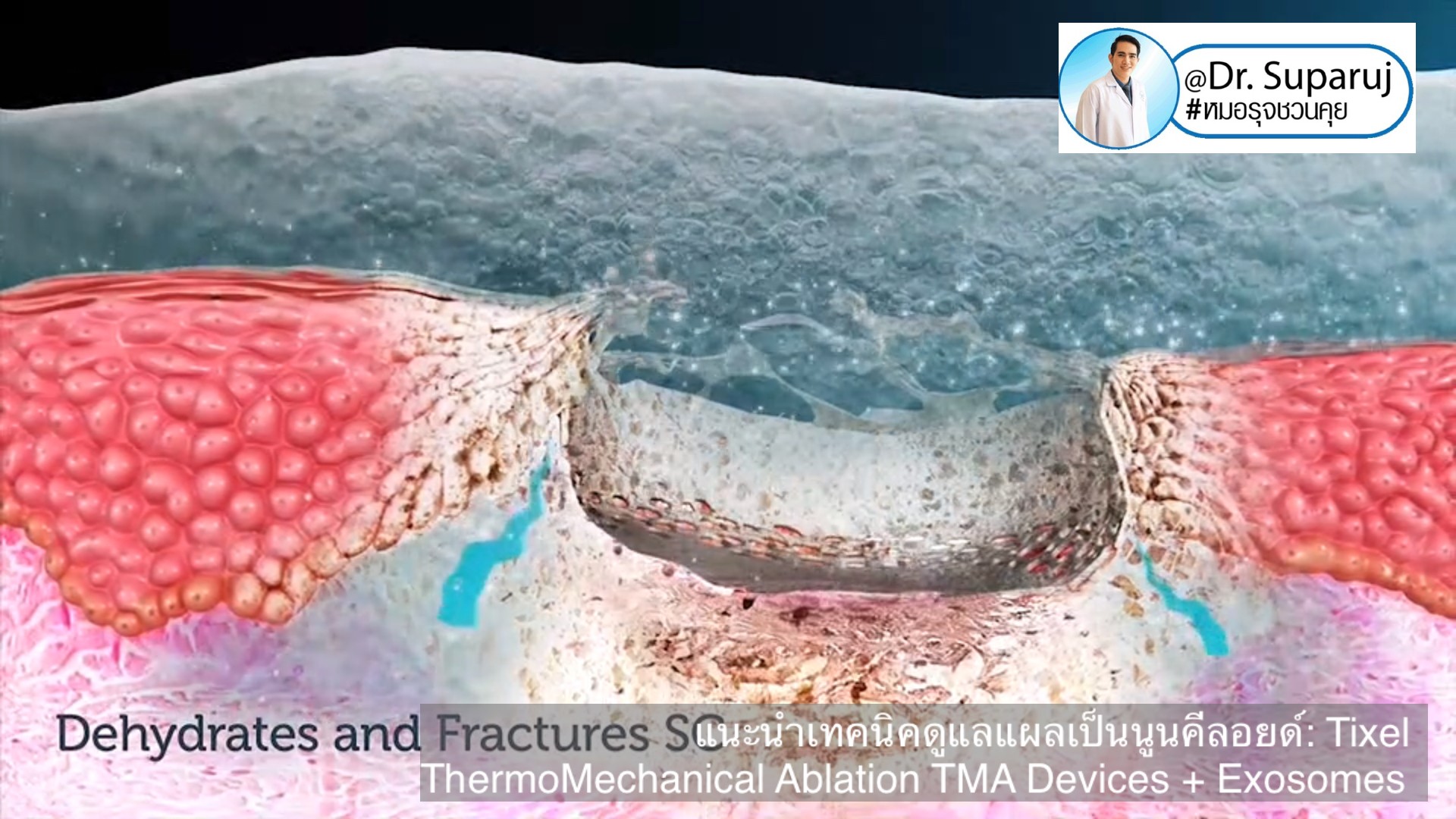 แนะนำเทคนิคดูแลแผลเป็นนูนคีลอยด์: รักษาแผลเป็นนูนด้วยทิกเซลล์ Tixel Fractional ThermoMechanical Ablation Devices + Exosomes