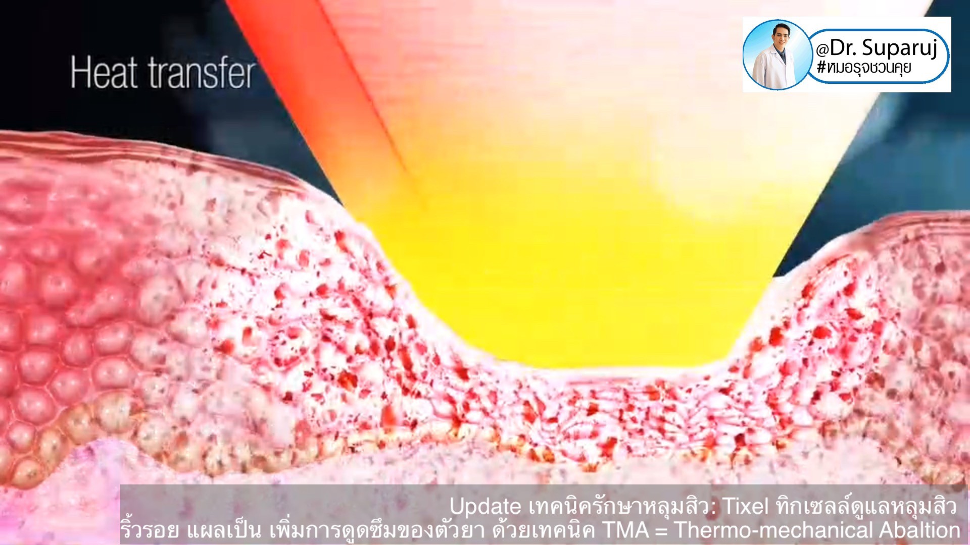 Update เทคนิครักษาหลุมสิว: Tixel ทิ๊กเซลล์ รักษาหลุมสิว ริ้วรอย แผลเป็น เพิ่มการดูดซึมยาด้วยเทคนิค TMA = Thermo-mechanical Abaltion Update เทคนิครักษาหลุมสิว: Tixel ทิ๊กเซลล์ รักษาหลุมสิว ริ้วรอย แผลเป็น เพิ่มการดูดซึมยาด้วยเทคนิค TMA = Thermo-mechanical Abaltion