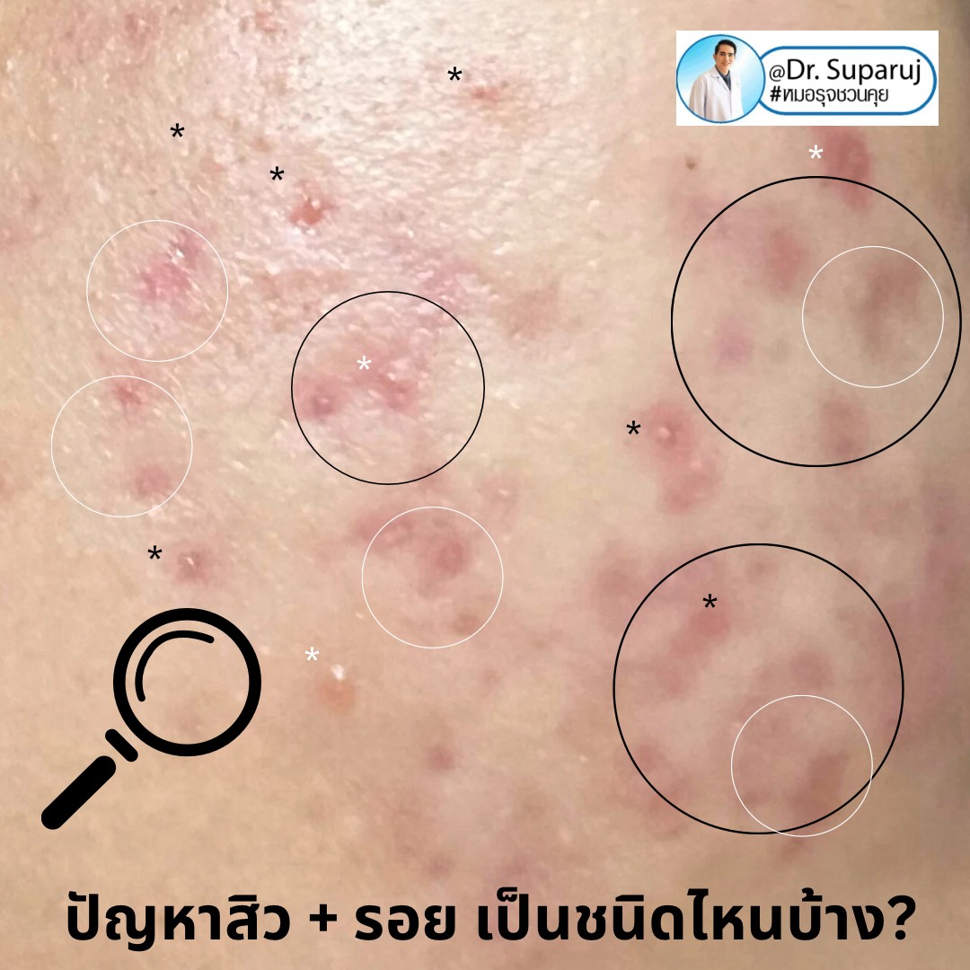 ปัญหาสิว + รอย เป็นชนิดไหนบ้าง? ปัญหาสิว + รอย เป็นชนิดไหนบ้าง?