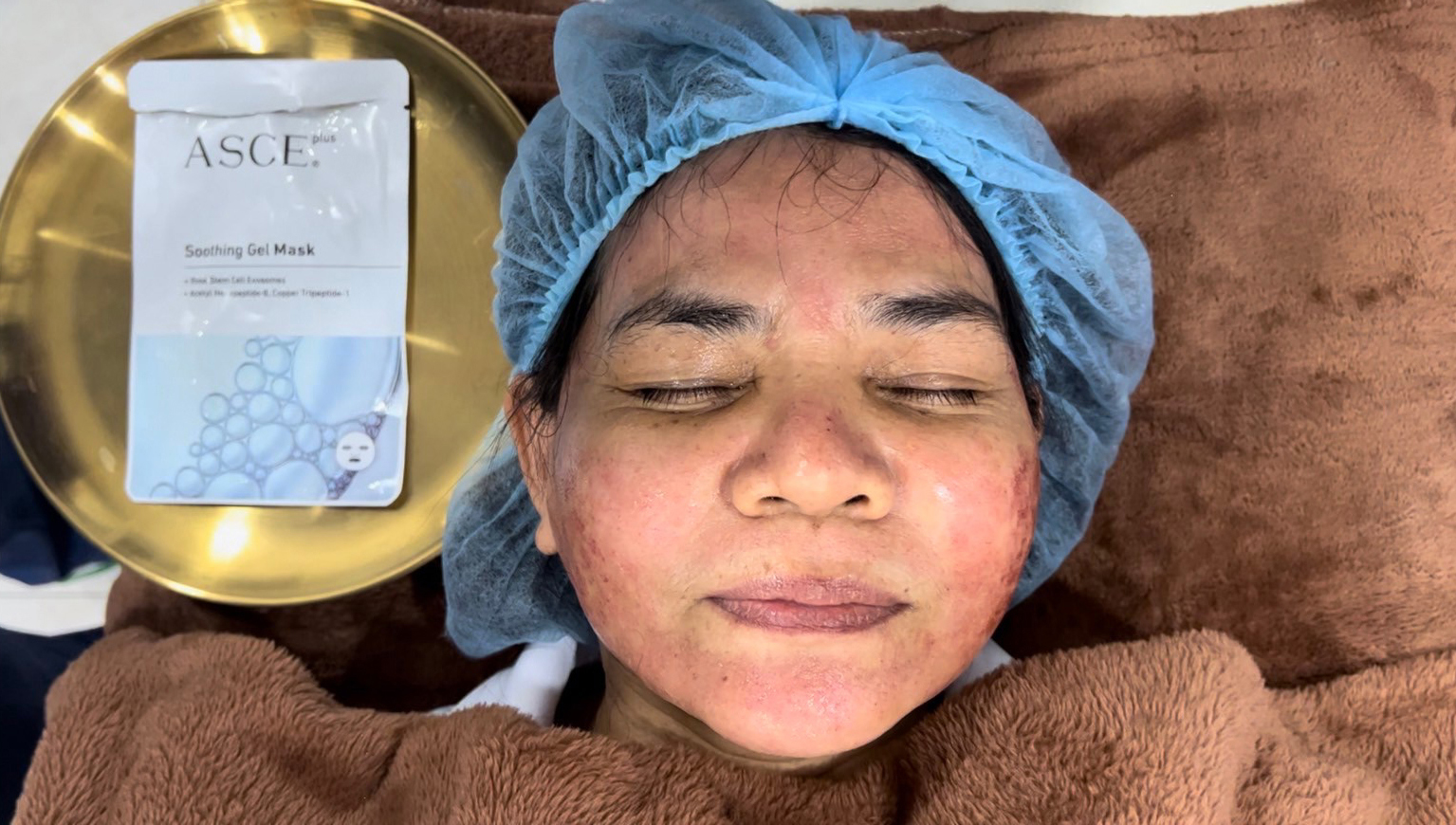 เทคนิคดูแลผิวลดรอยแดงหลังการรักษาหลุมสิว Discovery Pico Laser ด้วย ASCE + Soothing Gel Mask: ช่วยลดรอยแดงได้จริงไหม ? (ท้ายคลิปมีตัวอย่างผลการรักษาครับ) เทคนิคดูแลผิวลดรอยแดงหลังการรักษาหลุมสิว Discovery Pico Laser ด้วย ASCE + Soothing Gel Mask: ช่วยลดรอยแดงได้จริงไหม ? (ท้ายคลิปมีตัวอย่างผลการรักษาครับ)
