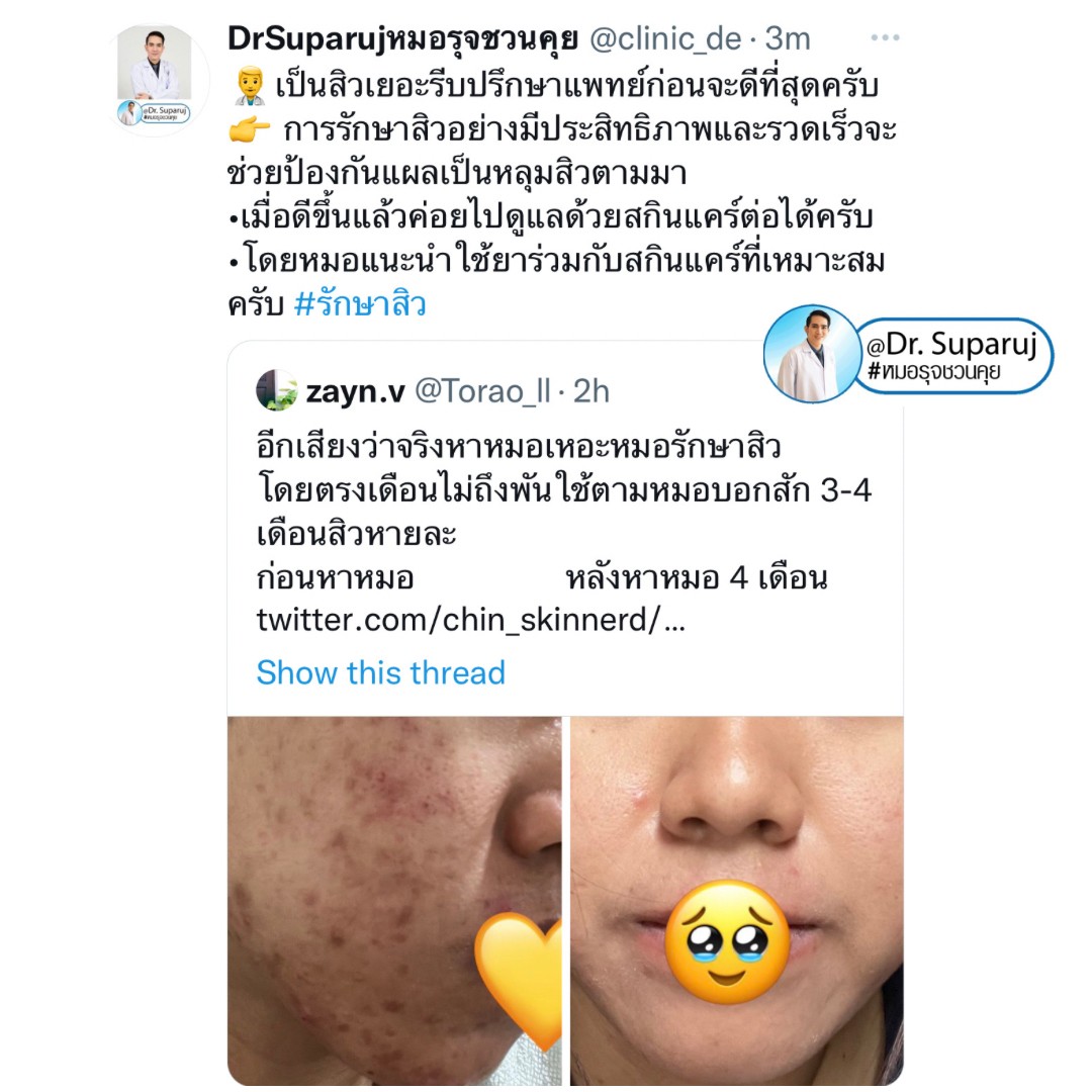 มีปัญหาหลุมสิว แต่ยังมีสิวขึ้นอยู่ สามารถรักษาหลุมสิวได้เลยไหม หรือควรดูแลอย่างไร? มีปัญหาหลุมสิว แต่ยังมีสิวขึ้นอยู่ สามารถรักษาหลุมสิวได้เลยไหม หรือควรดูแลอย่างไร?