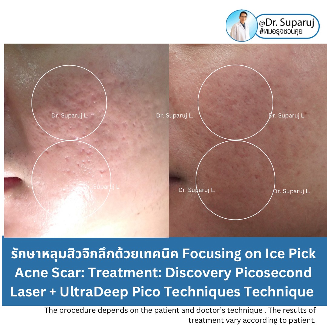 แนะนำเทคนิคดูแลรักษาหลุมสิว: เทคนิครักษาหลุมสิวด้วย 2 เทคนิคเสริมประสิทธิภาพ SYLFIRM X Plus + Discovery Pico Laser Combination Treatment