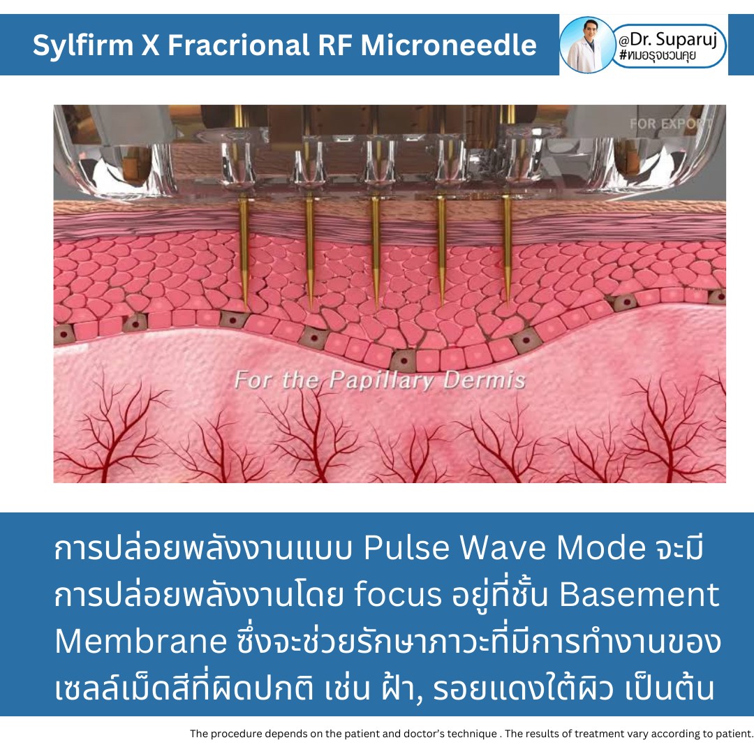Update เทคนิคยกกระชับผิว หลุมสิว ดูแลปัญหาเม็ดสี ฝ้า+เส้นเลือด ด้วยนวัตกรรมคลื่นวิทยุแบบเข็ม Fractional microneedle Radiofrequency : SYLFIRM X Update เทคนิคยกกระชับผิว หลุมสิว ดูแลปัญหาเม็ดสี ฝ้า+เส้นเลือด ด้วยนวัตกรรมคลื่นวิทยุแบบเข็ม Fractional microneedle Radiofrequency : SYLFIRM X