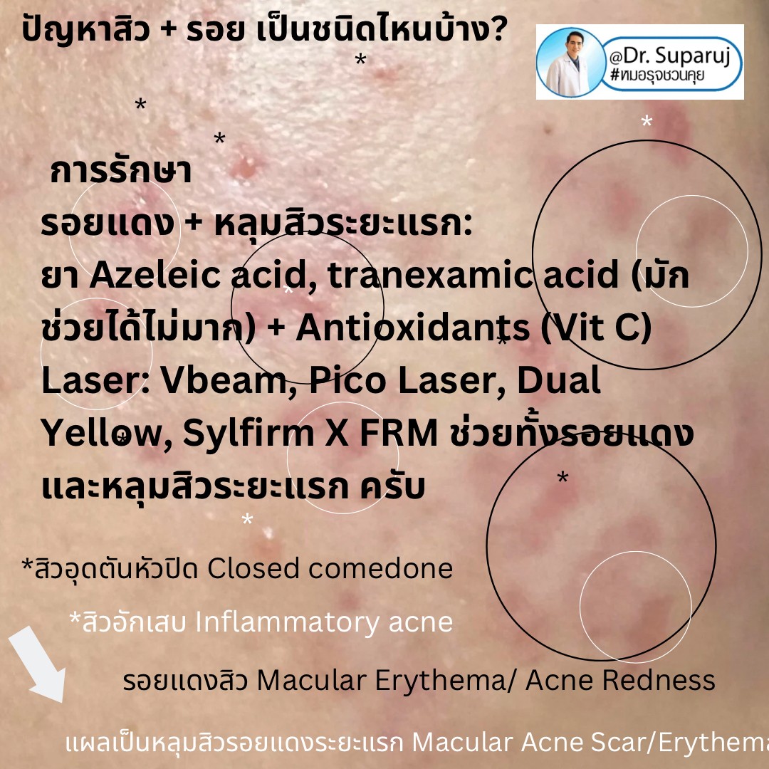 ปัญหาสิว + รอย เป็นชนิดไหนบ้าง? ปัญหาสิว + รอย เป็นชนิดไหนบ้าง?