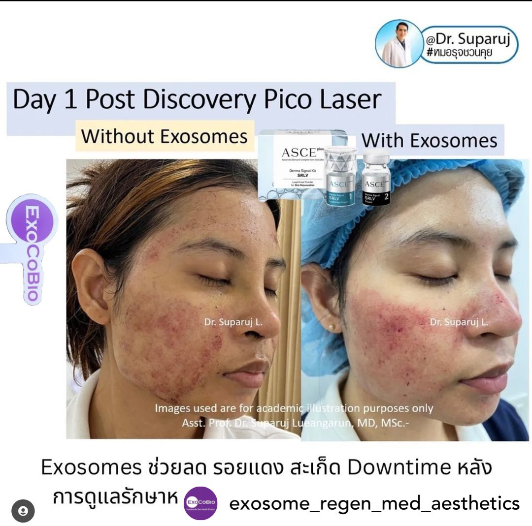 Exosomes มีบทบาทและกลไกในการดูแลฝ้า หรือไม่ & กลไกลเป็นอย่างไร ? Exosomes มีบทบาทและกลไกในการดูแลฝ้า หรือไม่ & กลไกลเป็นอย่างไร ?