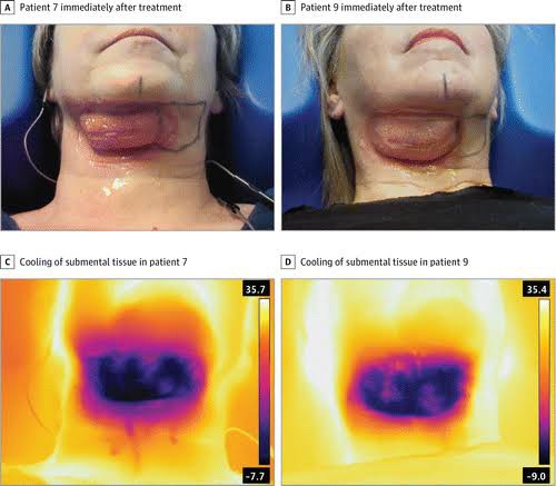 สาเหตุ & เทคนิคลดเหนียง ไขมันใต้คาง คาง 2 ชั้น Double Chin & Submental Fullness Treatment  สาเหตุ & เทคนิคลดเหนียง ไขมันใต้คาง คาง 2 ชั้น Double Chin & Submental Fullness Treatment