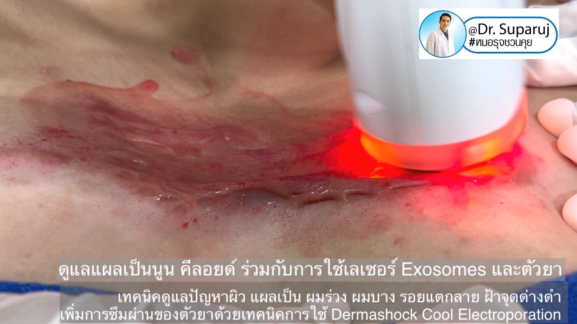 เทคนิคดูแลปัญหาผิว แผลเป็น ผมร่วง ผมบาง รอยแตกลาย ฝ้าจุดด่างดำ เพิ่มการซึมผ่านของตัวยาด้วยเทคนิคการใช้ Dermashock Cool Electroporation เทคนิคดูแลปัญหาผิว แผลเป็น ผมร่วง ผมบาง รอยแตกลาย ฝ้าจุดด่างดำ เพิ่มการซึมผ่านของตัวยาด้วยเทคนิคการใช้ Dermashock Cool Electroporation