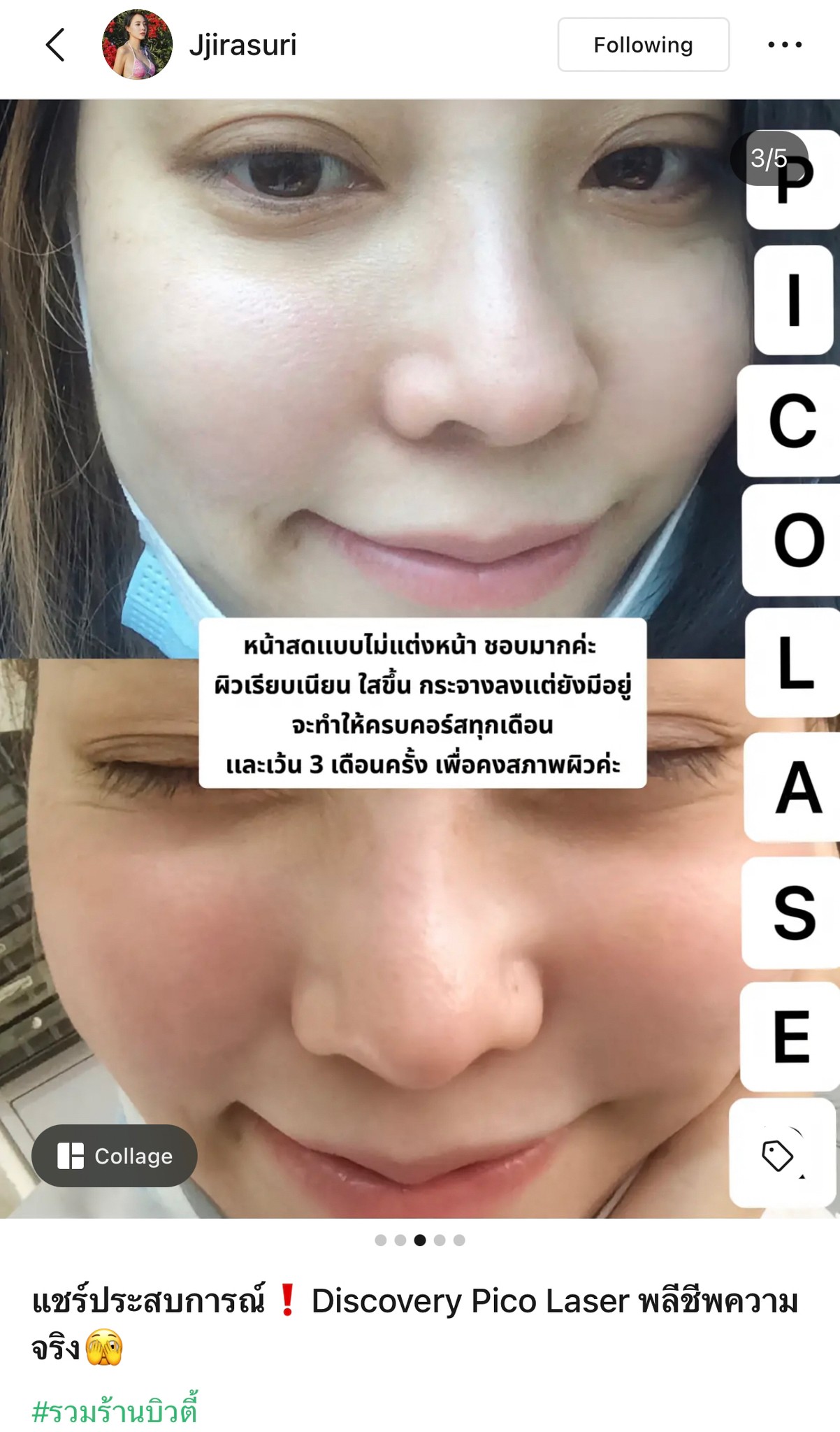 แชร์ประสบการณ์ Discovery Pico Laser พลีชีพความจริง แชร์ประสบการณ์ Discovery Pico Laser พลีชีพความจริง