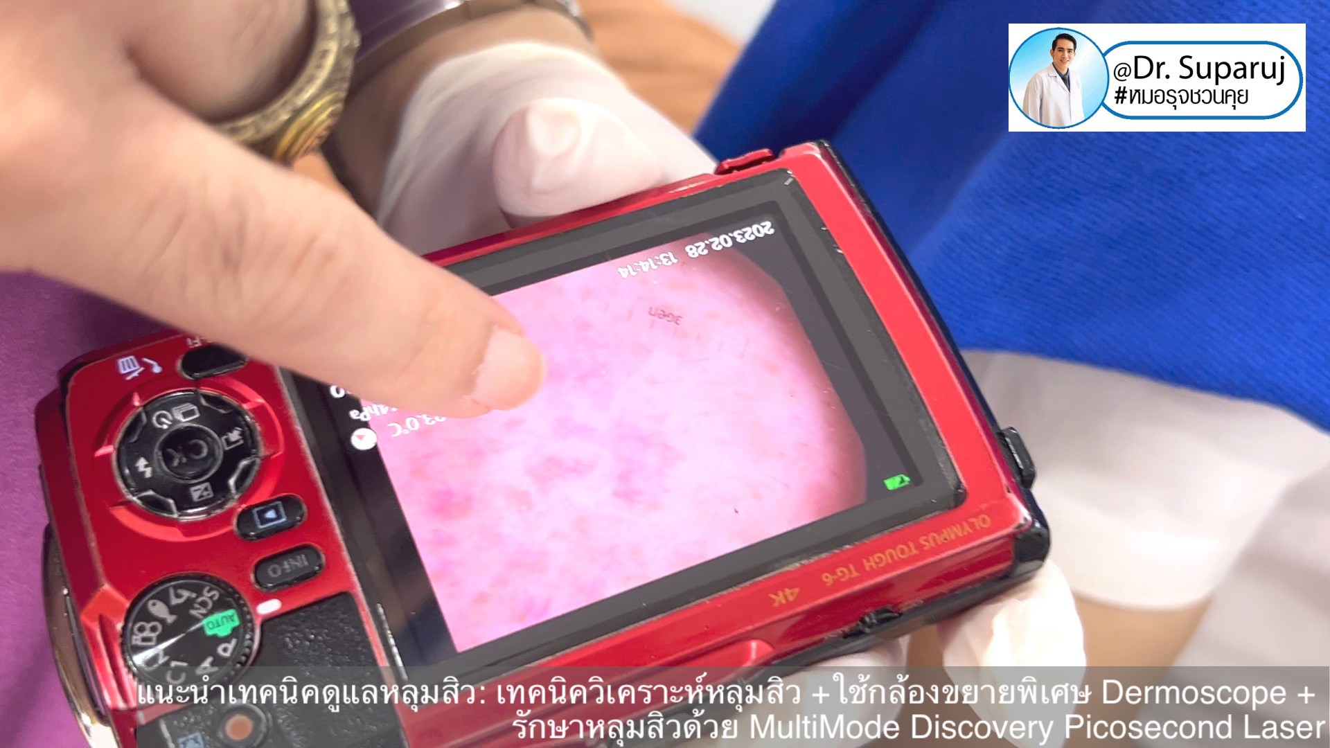 แนะนำเทคนิคดูแลหลุมสิว: เทคนิควิเคราะห์หลุมสิว +ใช้กล้องขยายพิเศษ Dermoscope + รักษาหลุมสิวด้วย MultiMode Discovery Picosecond Laser + Exosome Therapy