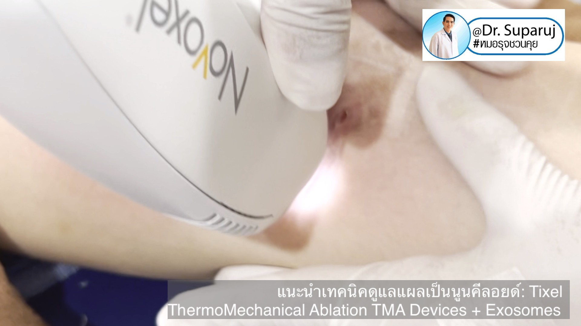 แนะนำเทคนิคดูแลแผลเป็นนูนคีลอยด์: รักษาแผลเป็นนูนด้วยทิกเซลล์ Tixel Fractional ThermoMechanical Ablation Devices + Exosomes แนะนำเทคนิคดูแลแผลเป็นนูนคีลอยด์: รักษาแผลเป็นนูนด้วยทิกเซลล์ Tixel Fractional ThermoMechanical Ablation Devices + Exosomes