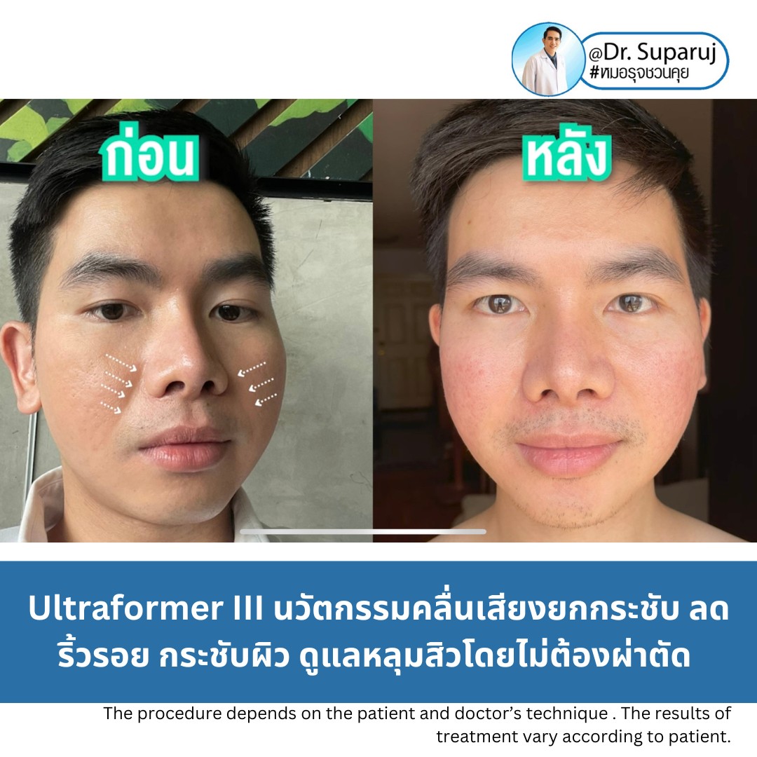 เทคโนโลยียกกระชับผิว MMFU : Micro &Macro Focused Ultrasound ของ Ultraformer III ทำงานอย่างไร ทำไมถึงดีกว่า HIFU ? เทคโนโลยียกกระชับผิว MMFU : Micro &Macro Focused Ultrasound ของ Ultraformer III ทำงานอย่างไร ทำไมถึงดีกว่า HIFU ?
