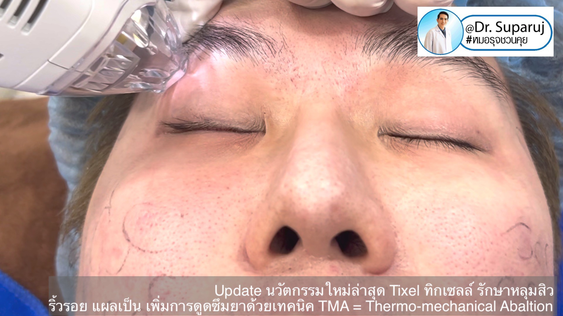 Update นวัตกรรมใหม่ล่าสุด Tixel ทิ๊กเซลล์ รักษาหลุมสิว ริ้วรอย แผลเป็น + Periorbital Tixel Treatment ดูแลริ้วรอยเปลือกตาและรอบดวงตาด้วยเทคนิค TMA = Thermo-mechanical Abaltion Update นวัตกรรมใหม่ล่าสุด Tixel ทิ๊กเซลล์ รักษาหลุมสิว ริ้วรอย แผลเป็น + Periorbital Tixel Treatment ดูแลริ้วรอยเปลือกตาและรอบดวงตาด้วยเทคนิค TMA = Thermo-mechanical Abaltion