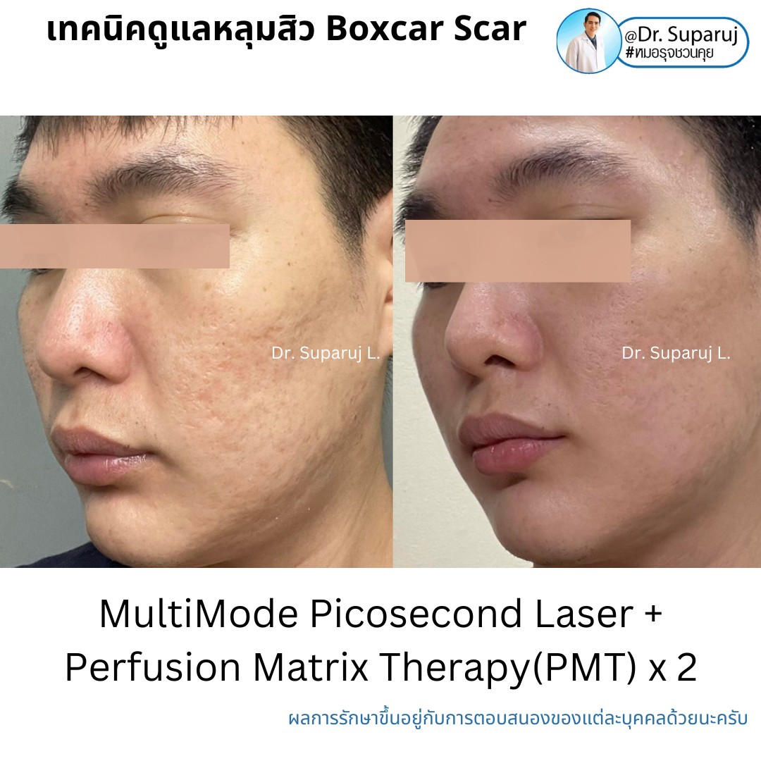 เทคนิคการดูแลหลุมสิว: ตัวอย่างการดูแลหลุมสิวแบบขอบชัดและแบบยุบตัวด้วยการใช้ Picosecond Laser + Perfusion Matrix Therapy