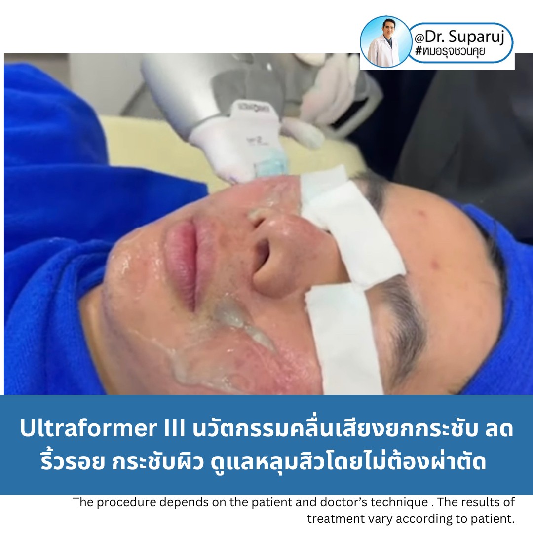 เทคโนโลยียกกระชับผิว MMFU : Micro &Macro Focused Ultrasound ของ Ultraformer III ทำงานอย่างไร ทำไมถึงดีกว่า HIFU ? เทคโนโลยียกกระชับผิว MMFU : Micro &Macro Focused Ultrasound ของ Ultraformer III ทำงานอย่างไร ทำไมถึงดีกว่า HIFU ?