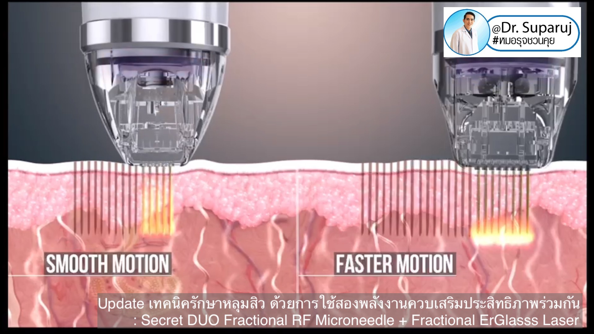 Update เทคนิครักษาหลุมสิว ด้วยการใช้สองพลังงานเสริมประสิทธิภาพร่วมกัน: Secret DUO Fractional RF Microneedle + Fractional ErGlasss Laser