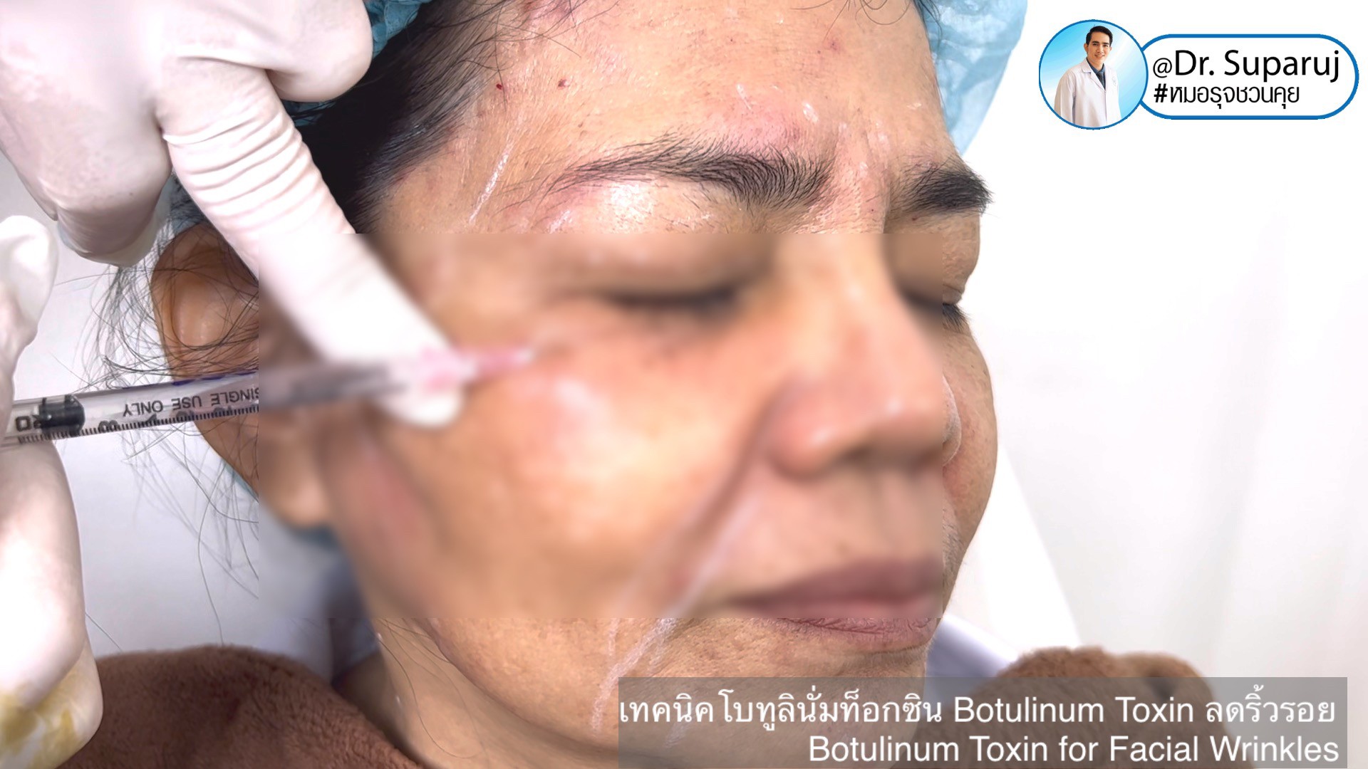 เทคนิคโบทูลินั่มท็อกซิน Botulinum Toxin ลดริ้วรอย Botulinum Toxin for Facial Wrinkles เทคนิคโบทูลินั่มท็อกซิน Botulinum Toxin ลดริ้วรอย Botulinum Toxin for Facial Wrinkles