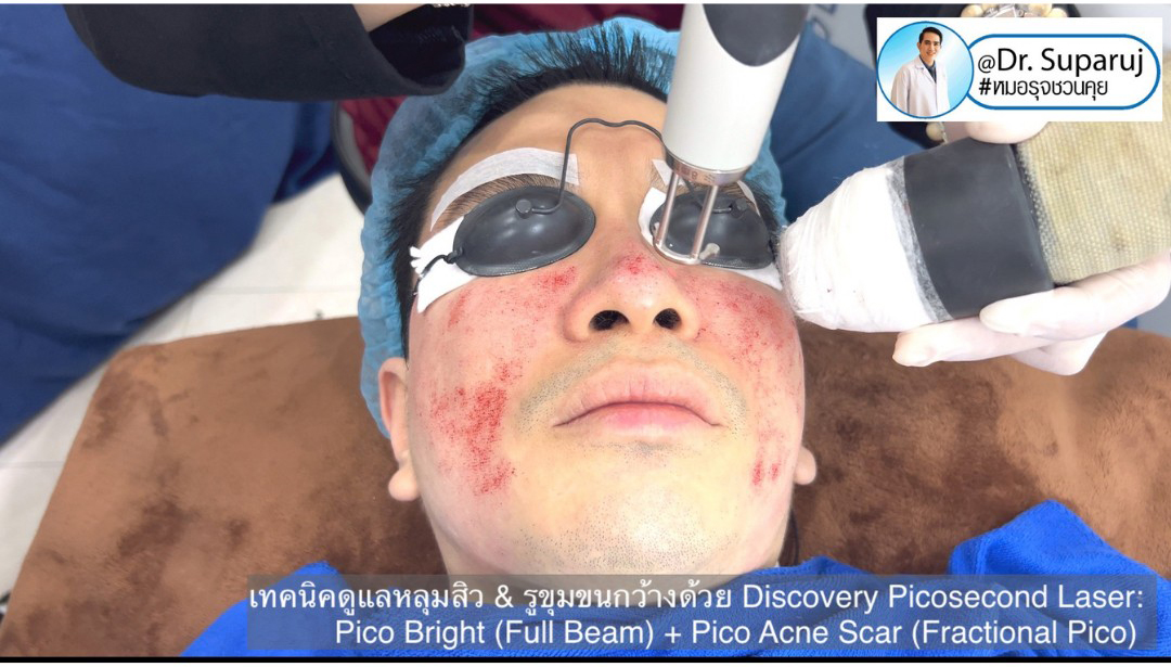 Update Discovery Picosecond Laser จุดเด่น & หลักการทำงาน ใช้ดูแลหลุมสิว แผลเป็น รอยแตกลาย ฝ้า กระจุดด่างดำ ได้อย่างไร ?  Update Discovery Picosecond Laser จุดเด่น & หลักการทำงาน ใช้ดูแลหลุมสิว แผลเป็น รอยแตกลาย ฝ้า กระจุดด่างดำ ได้อย่างไร ?