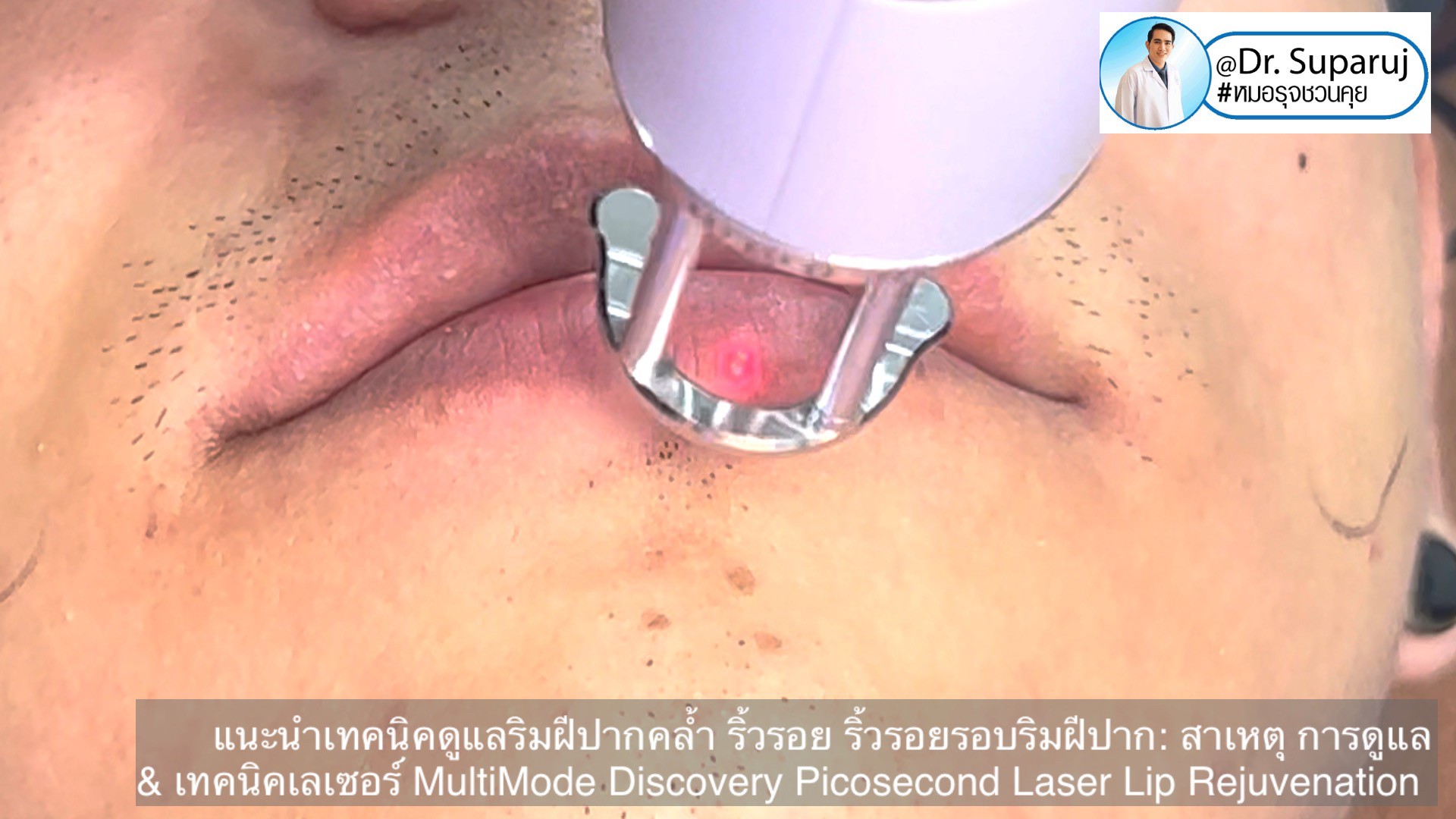 แนะนำเทคนิคดูแลริมฝีปากคล้ำ Lip Hyperpigmentation ริ้วรอย ริ้วรอยรอบริมฝีปาก: สาเหตุ การดูแล & เทคนิคเลเซอร์ MultiMode Discovery Picosecond Laser Lip Rejuvenation