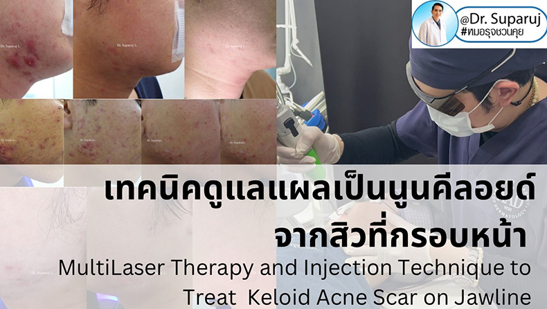  แนะนำเทคนิคดูแลแผลเป็นนูนคีลอยด์จากสิวที่กรอบหน้า MultiLaser Therapy and Injection Technique to Treat Keloid Acne Scar on Jawline