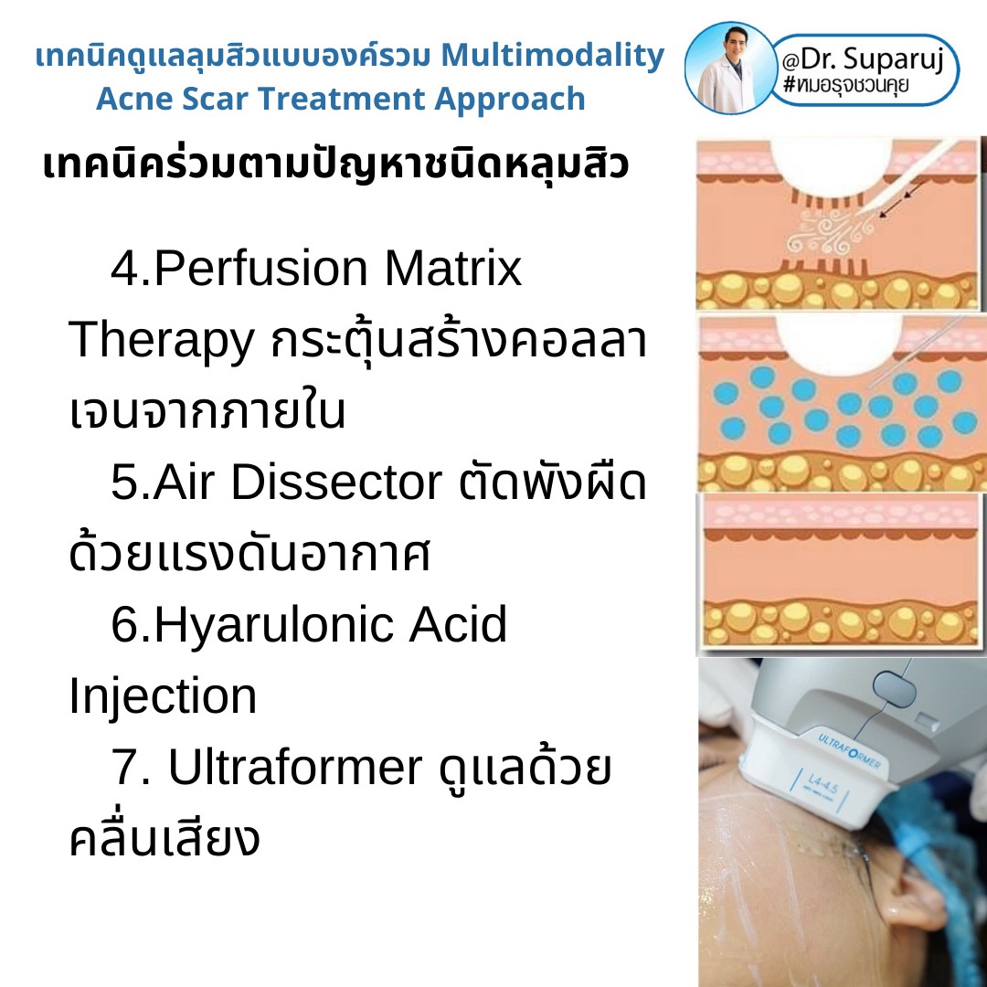 มีปัญหาหลุมสิว แต่ยังมีสิวขึ้นอยู่ สามารถรักษาหลุมสิวได้เลยไหม หรือควรดูแลอย่างไร? มีปัญหาหลุมสิว แต่ยังมีสิวขึ้นอยู่ สามารถรักษาหลุมสิวได้เลยไหม หรือควรดูแลอย่างไร?