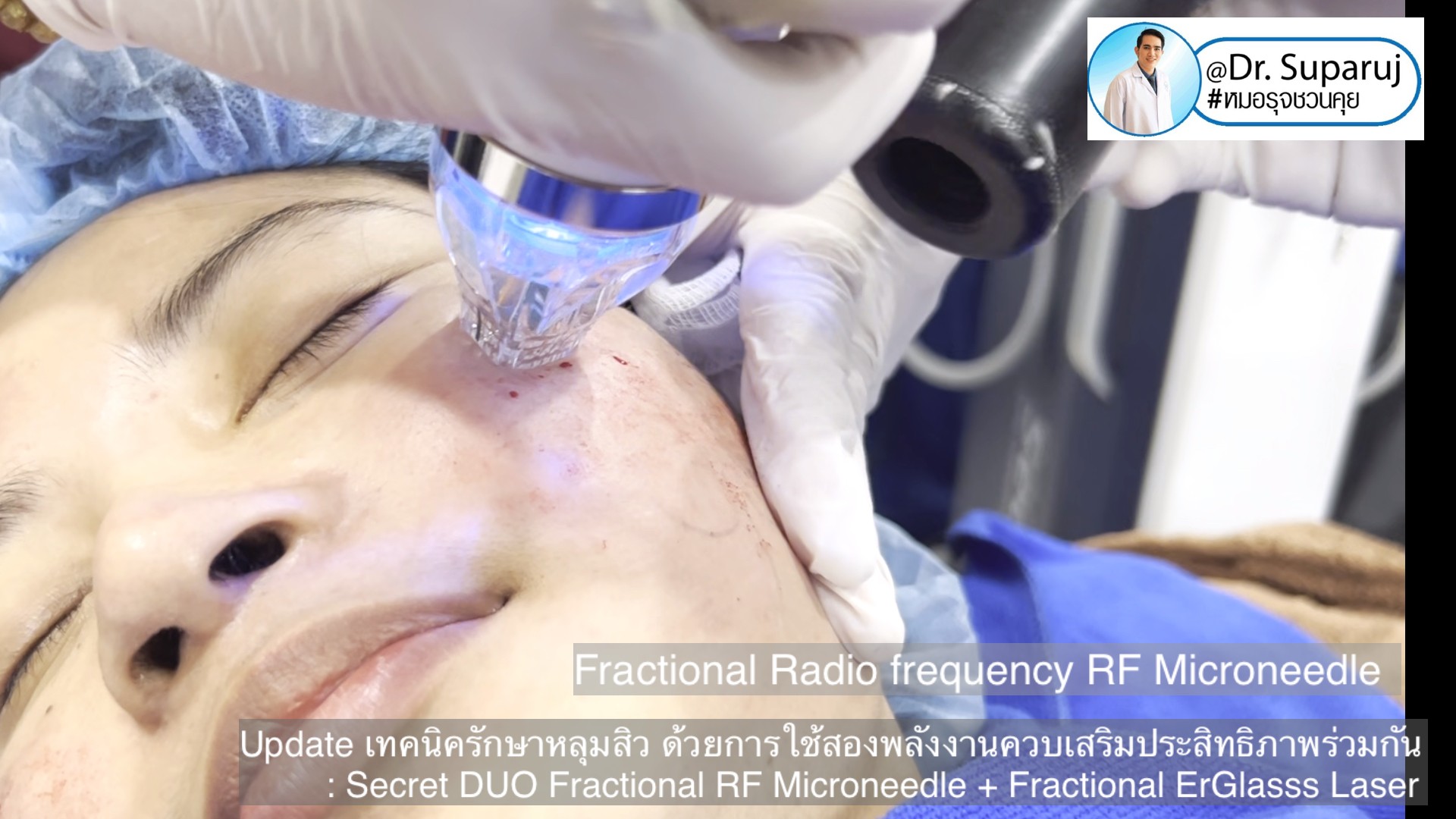 Update เทคนิครักษาหลุมสิว ด้วยการใช้สองพลังงานเสริมประสิทธิภาพร่วมกัน: Secret DUO Fractional RF Microneedle + Fractional ErGlasss Laser