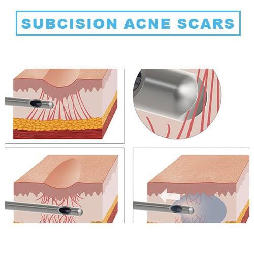 Update รักษาหลุมสิวด้วยเทคนิคการตัดพังผืด Blunt Blade Subcision (Blunt Blade Subcision for Acne Scar Fibrosis Treatment) Update รักษาหลุมสิวด้วยเทคนิคการตัดพังผืด Blunt Blade Subcision (Blunt Blade Subcision for Acne Scar Fibrosis Treatment)