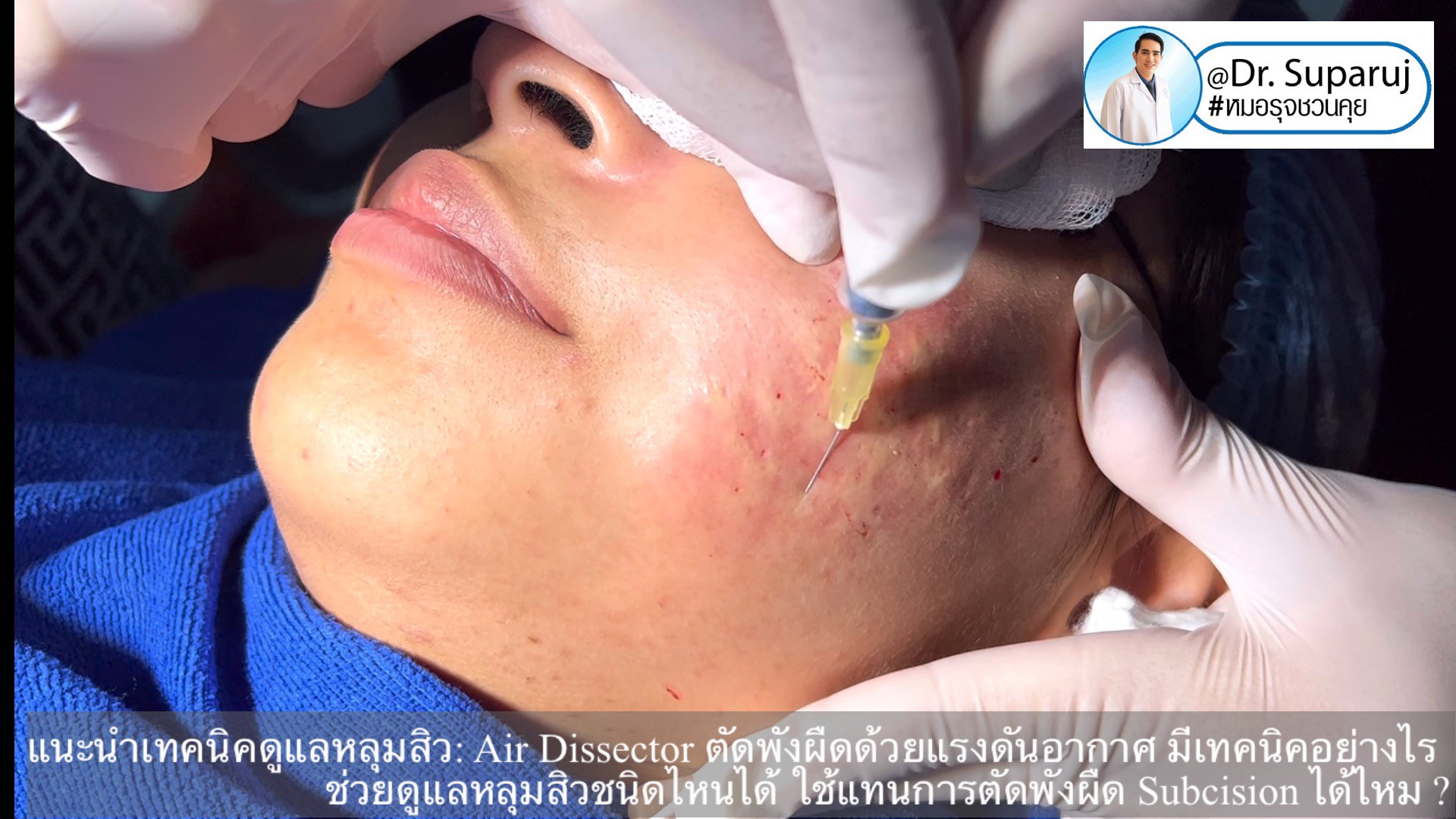 แนะนำเทคนิคดูแลหลุมสิว: Air Dissector ตัดพังผืดด้วยแรงดันอากาศ มีเทคนิคอย่างไร ช่วยดูแลหลุมสิวชนิดไหนได้ ใช้แทนการตัดพังผืด Subcision ได้ไหม ? แนะนำเทคนิคดูแลหลุมสิว: Air Dissector ตัดพังผืดด้วยแรงดันอากาศ มีเทคนิคอย่างไร ช่วยดูแลหลุมสิวชนิดไหนได้ ใช้แทนการตัดพังผืด Subcision ได้ไหม ?