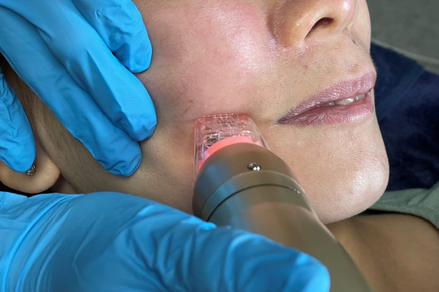 Update เทคนิคยกกระชับผิว หลุมสิว ดูแลปัญหาเม็ดสี ฝ้า+เส้นเลือด: SYLFIRM X นวัตกรรมคลื่นวิทยุแบบเข็ม (Fractional microneedle Radiofrequency) Update เทคนิคยกกระชับผิว หลุมสิว ดูแลปัญหาเม็ดสี ฝ้า+เส้นเลือด: SYLFIRM X นวัตกรรมคลื่นวิทยุแบบเข็ม (Fractional microneedle Radiofrequency)